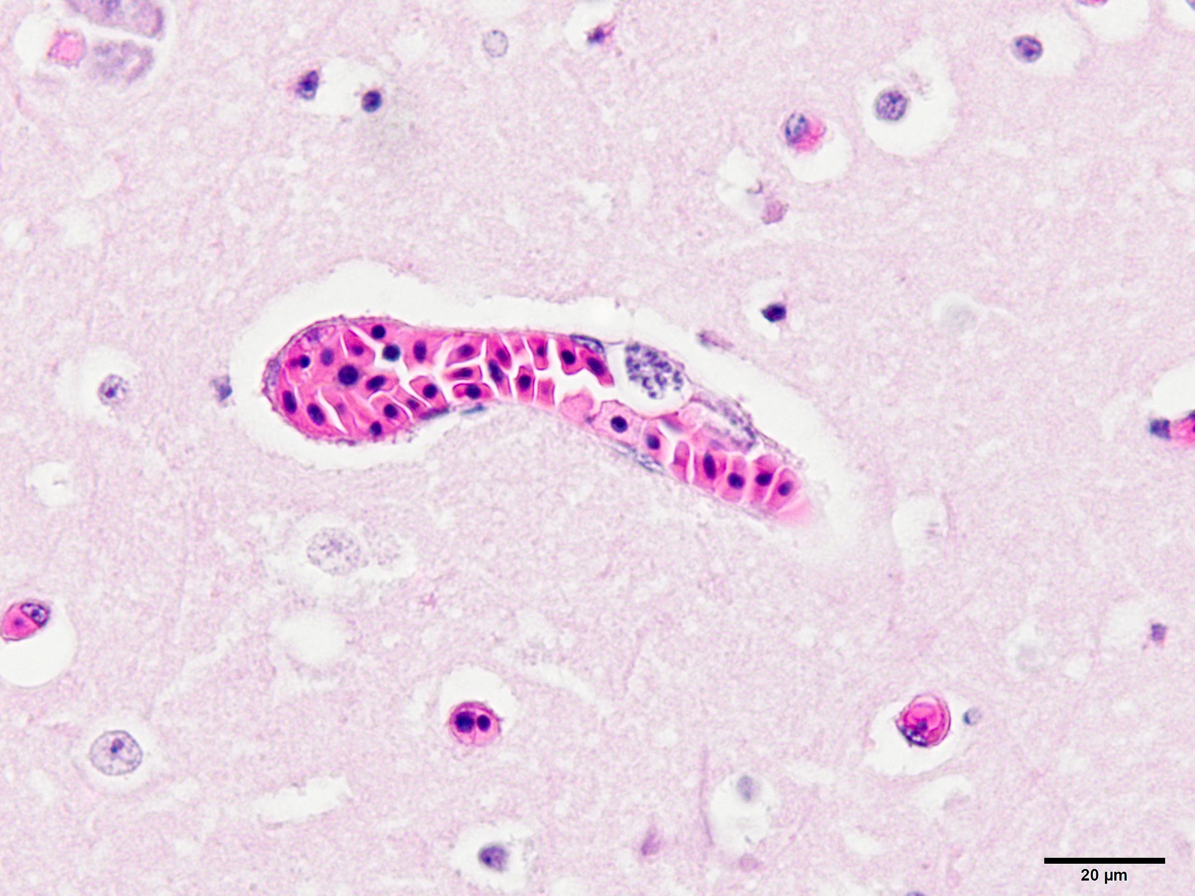 A microscopic image of the malaria parasites from the specimen's brain wall. Inga Sidor